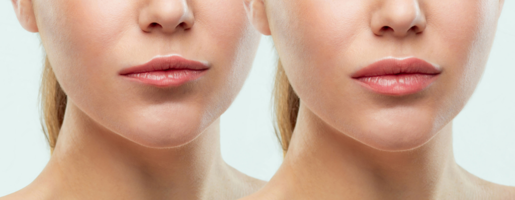 Lip Fillers Calgary